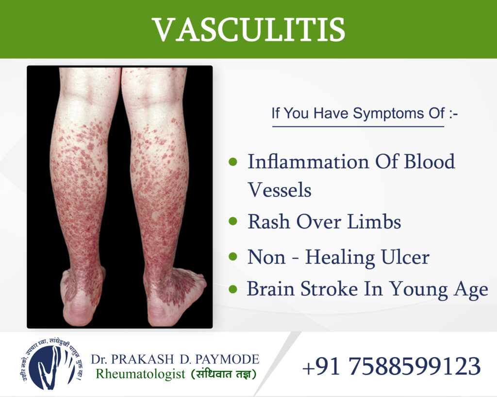 Vasculitis Drprakashpaymode 